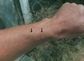 wrist tendonitis treatment